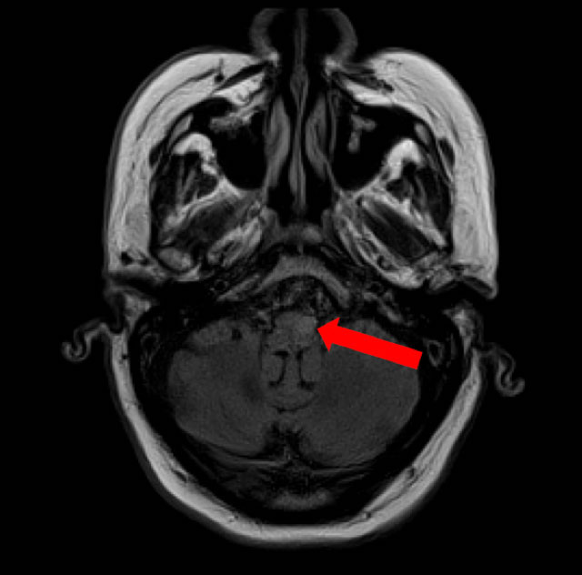 An MRI scan shows part of the brain. An arrow is superimposed, pointing at a round structure in the center.