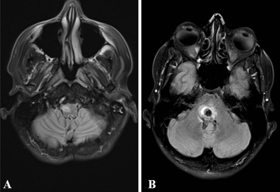 A composite image shows two MRI scans of the brain. One is labeled A and the other is labeled B.
