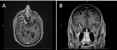 A composite imgae shows two MRI views of the brain. The one on the left is labeled A and the one on the right is labeled B.