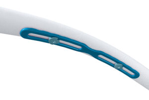 A blue AdvantageRib fixation plate is attached to the inner surface of a curved, broken rib using very small incisions, fiber optics and low-profile bolts