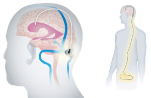 Cranial Devices, Inc. HydroFix shunt graphic, depicting the device’s small size and length confined to the head in comparison to the standard brain shunt, which runs down the torso into the abdomen