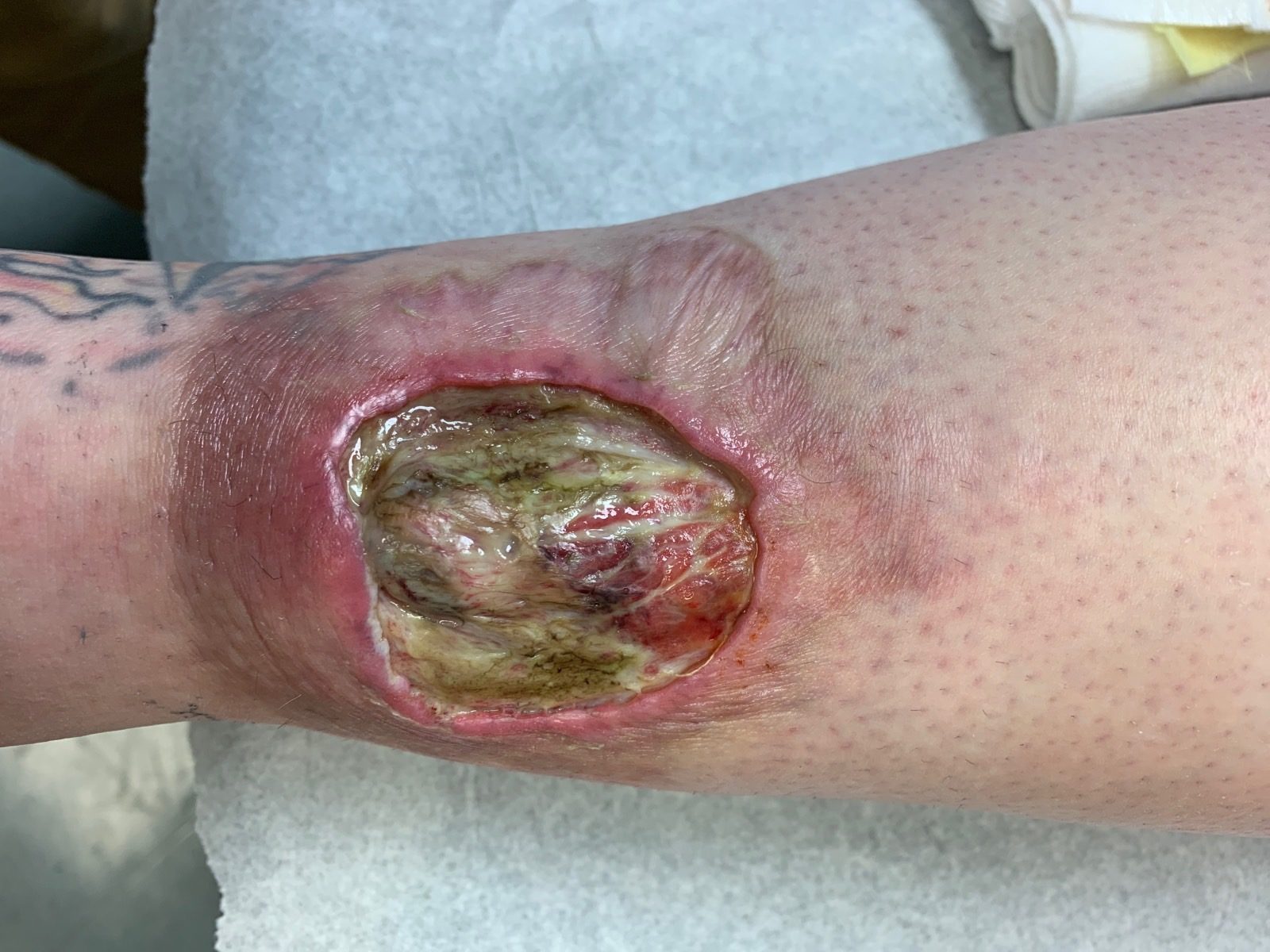 Ulcer with violaceous rolled borders, purulent base and granulation tissue