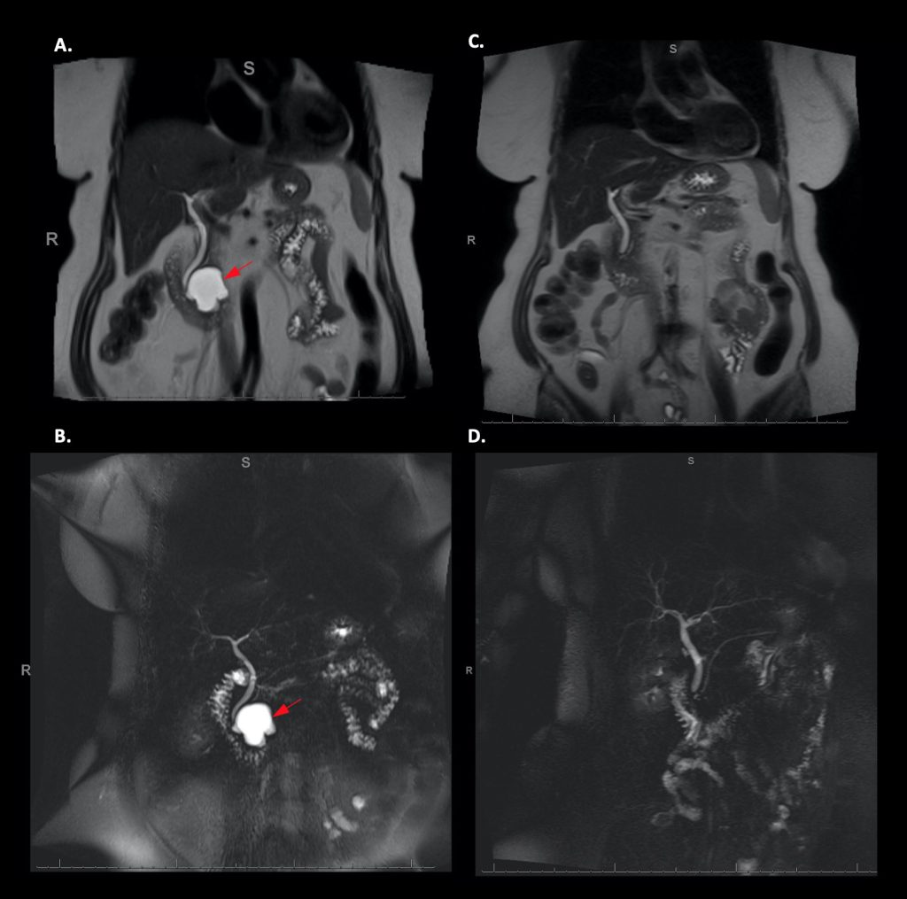 A series of four MRI and MRCP scans of a patient’s precancerous pancreatic cyst. Images on left side have a brighter spot toward the middle of the images with an arrow pointing to them; on the right side, the spot is not there.