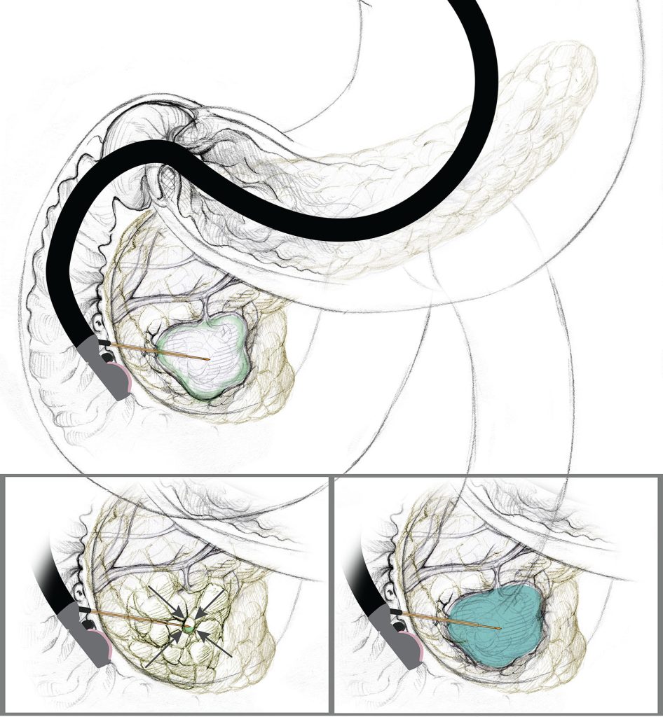 A scientific diagram depicting an EUS-guided cyst ablation process.