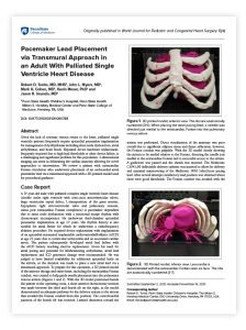 Thumbnail image of case study for Pacemaker Lead Placement via Transmural Approach in an Adult With Palliated Single Ventricle Heart Disease
