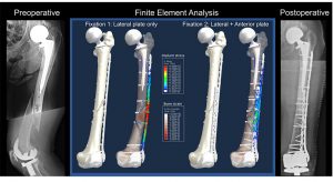 Preoperative and Postoperative x-rays of a femur where that was a fracture with four computer-created models from an analysis in the middle